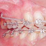 microimplantes de ortodoncia