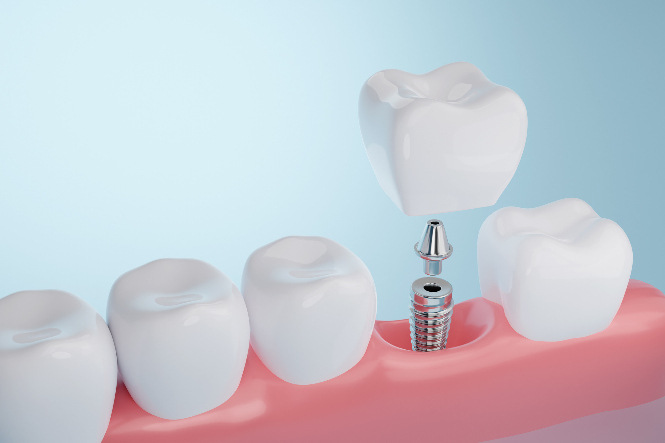 Implante dental cuidados