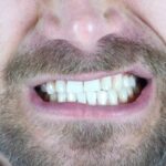 Bruxismo y sistema nervioso autónomo