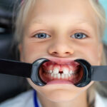 Diastemas en niños