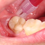 endocorona dental