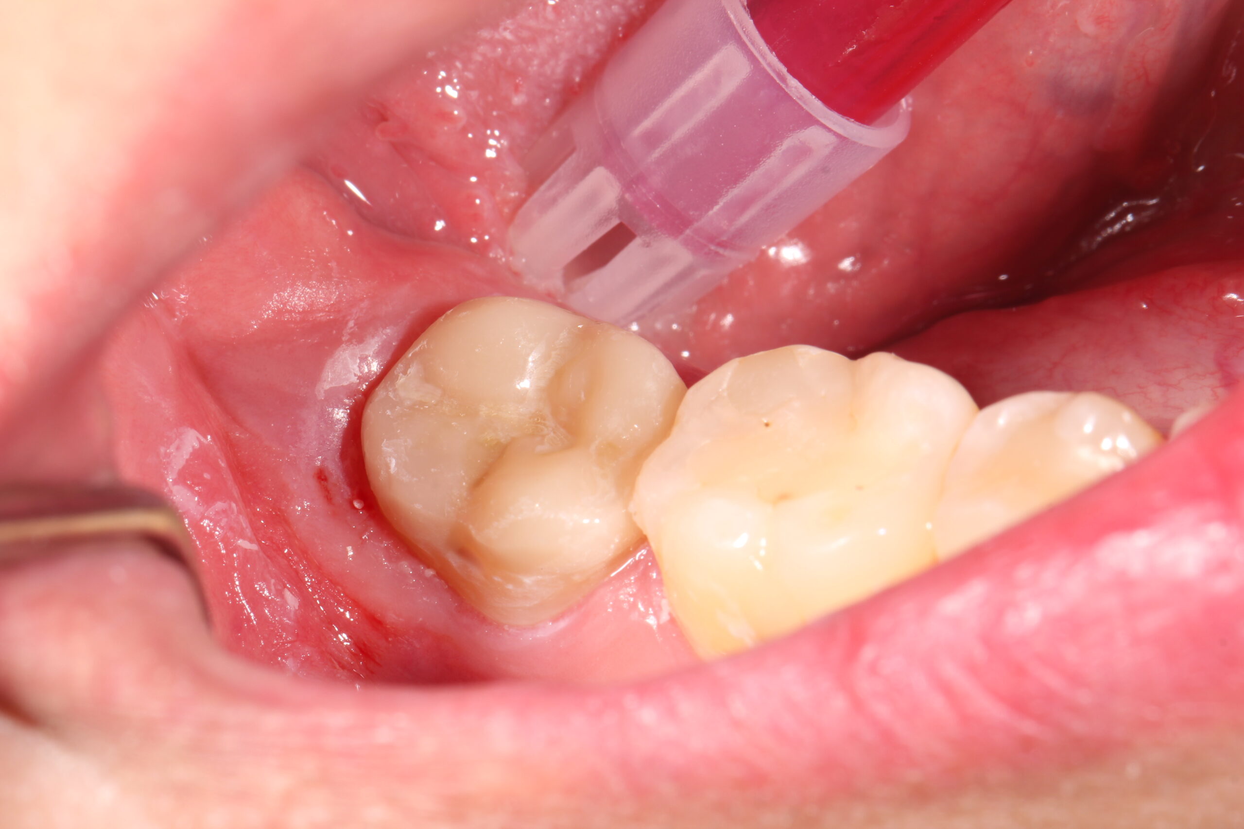 endocorona dental